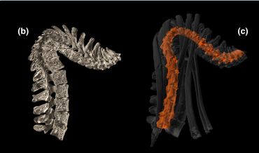 Reconstructions 3D d'une colonne vertébrale atteinte par la tuberculose